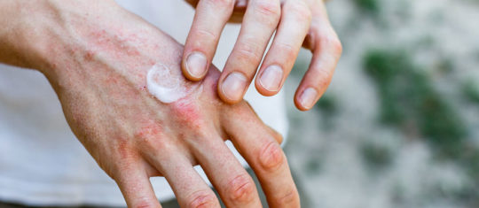 psoriasis
