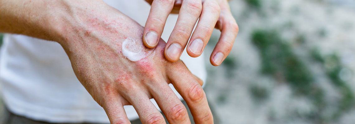 psoriasis